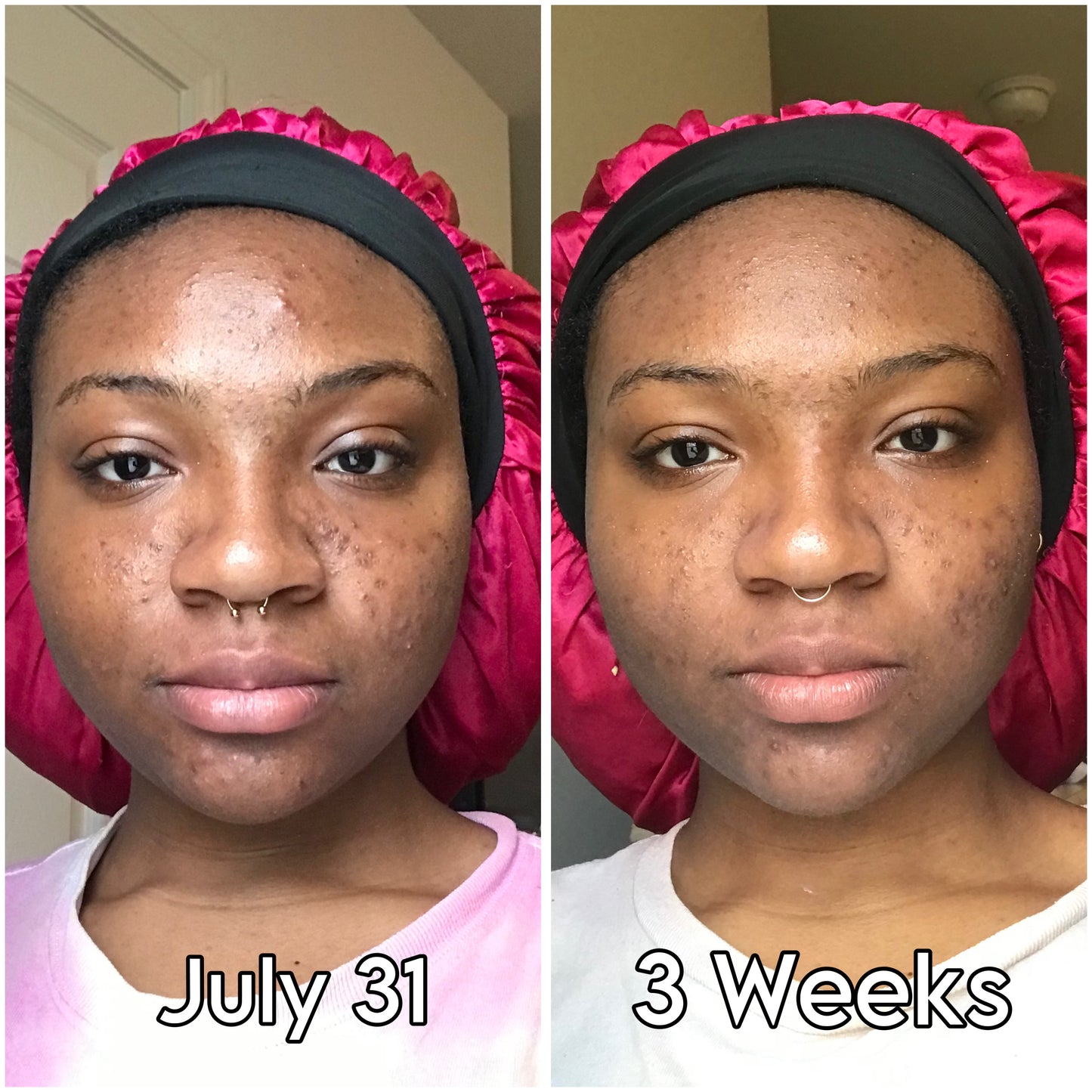 Turmeric & Kojic Acid Soap